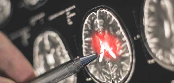 Brain injury placeholder image